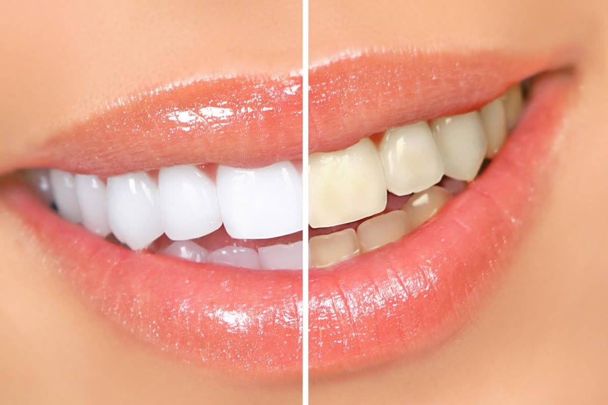 Clareamento dental em Rio Verde
