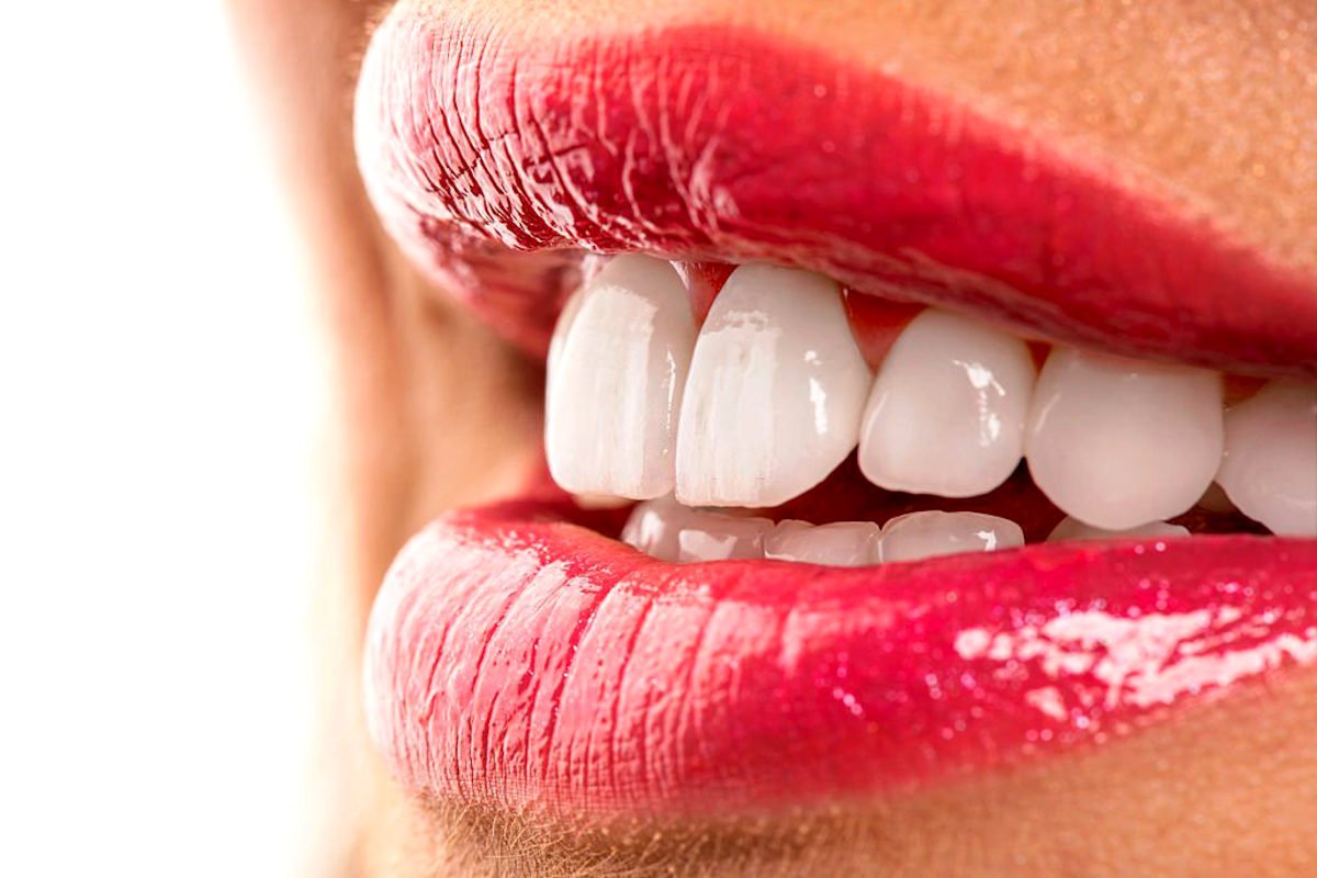 Facetas dentárias em Rio Verde