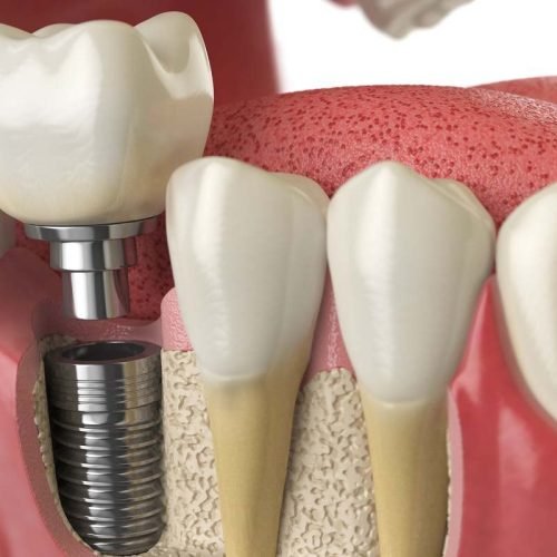 Implantes dentários em Rio Verde